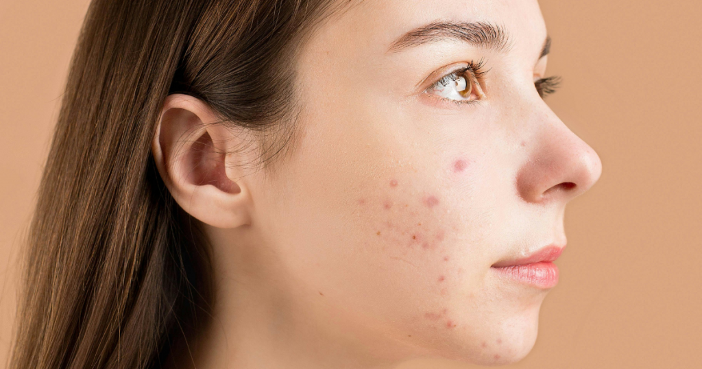 Young woman with acne